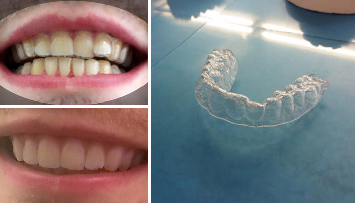 Este estudiante imprimió en 3D su propia ortodoncia por 60$