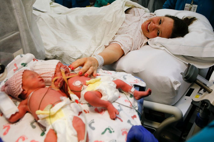 gemelas-monoamnioticas-dandose-mano-jenna-jillian-thistlethwaite (4)