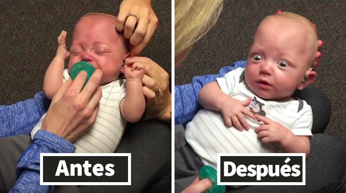 Este bebé escucha a su madre por 1ª vez tras recibir un audífono, su reacción te emocionará