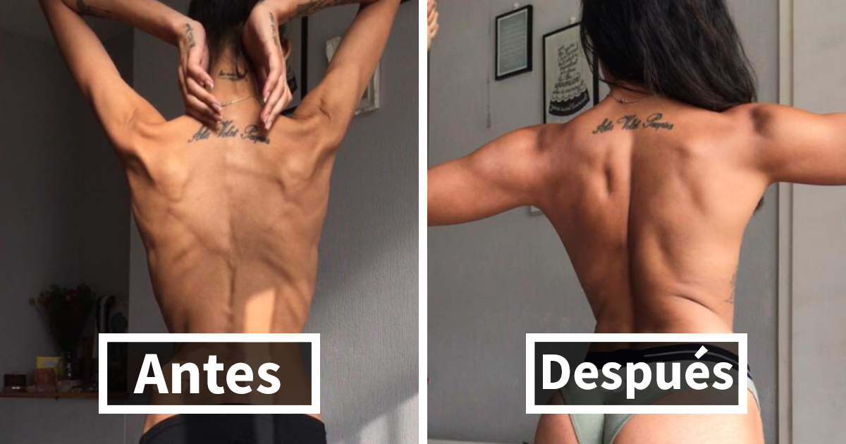 10+ Fotos antes y después de personas que derrotaron a la anorexia