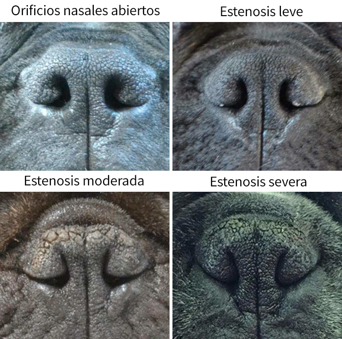 estenosis