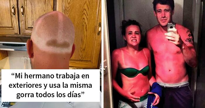 40 Personas que no se pusieron protector solar y acabaron pareciendo imbéciles