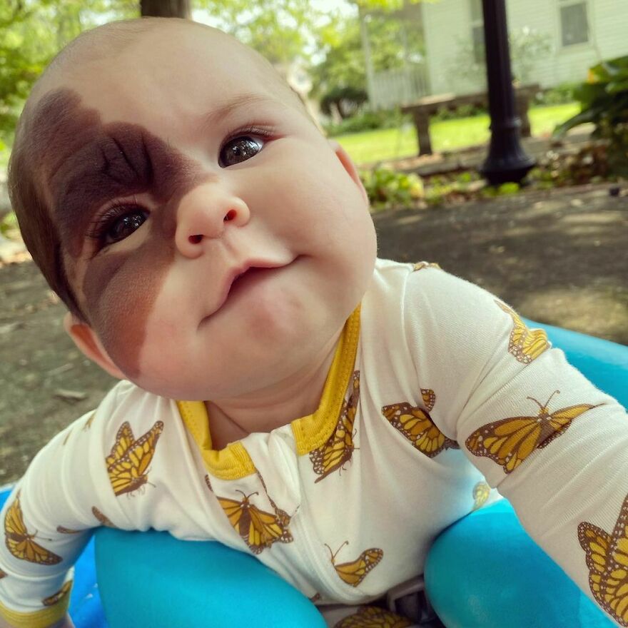 Esta bebé nació con una llamativa marca de nacimiento, y su familia lucha por normalizar su aspecto