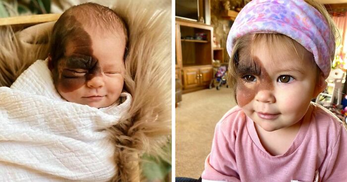 Esta bebé nació con una llamativa marca de nacimiento, y su familia lucha por normalizar su aspecto