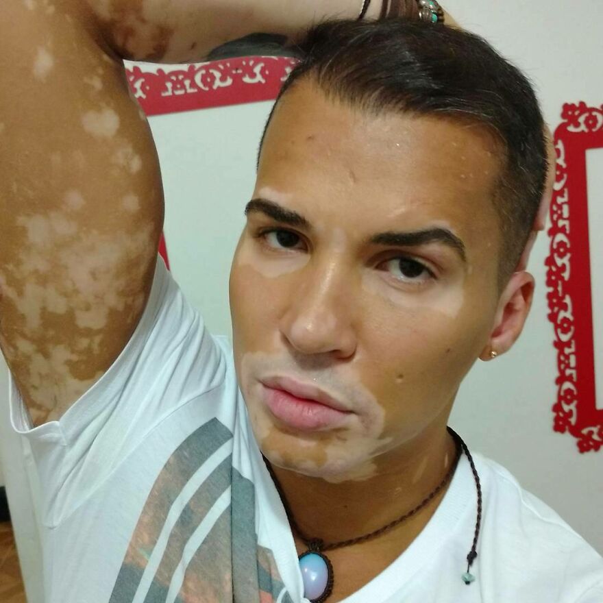 De la sombra a la luz: Este brasileño dejó de ocultar su vitiligo para triunfar como modelo