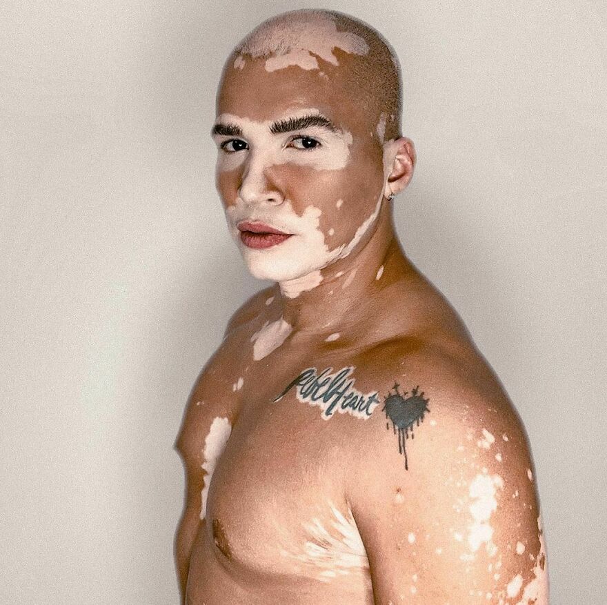 De la sombra a la luz: Este brasileño dejó de ocultar su vitiligo para triunfar como modelo