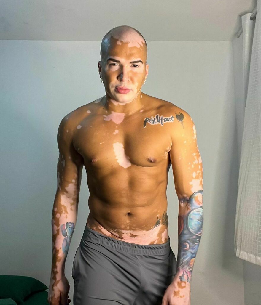 De la sombra a la luz: Este brasileño dejó de ocultar su vitiligo para triunfar como modelo