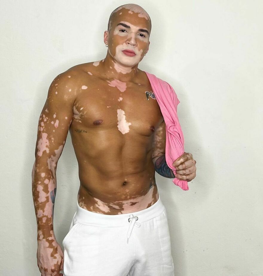 De la sombra a la luz: Este brasileño dejó de ocultar su vitiligo para triunfar como modelo