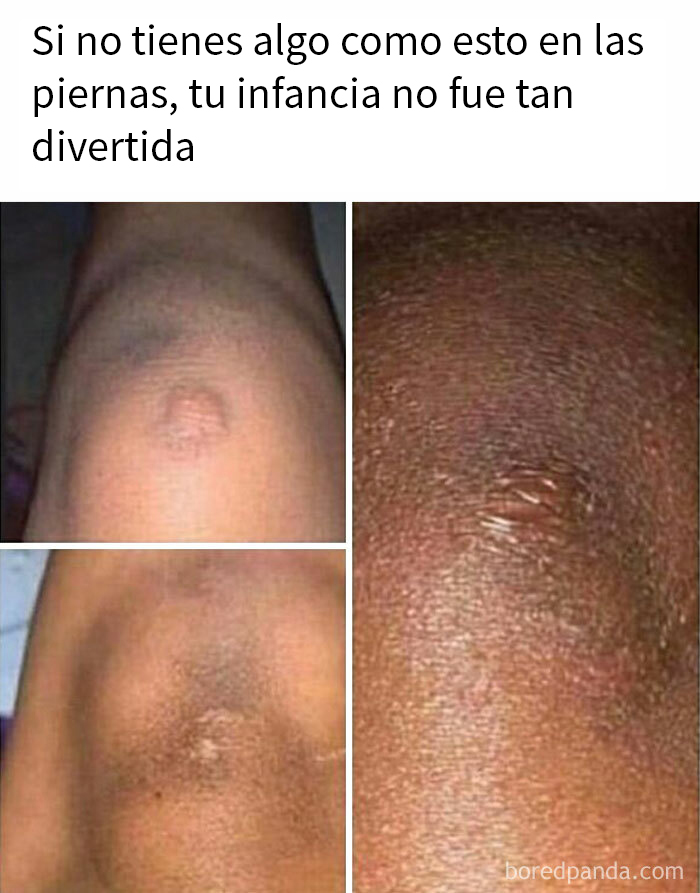 Memes sobre hombres mostrando cicatrices en las rodillas como recuerdo universal de la infancia divertida.