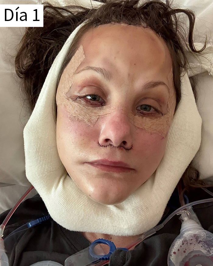 Mujer con vendajes y moretones en el rostro tras lifting facial, mostrando resultados del procedimiento estético.