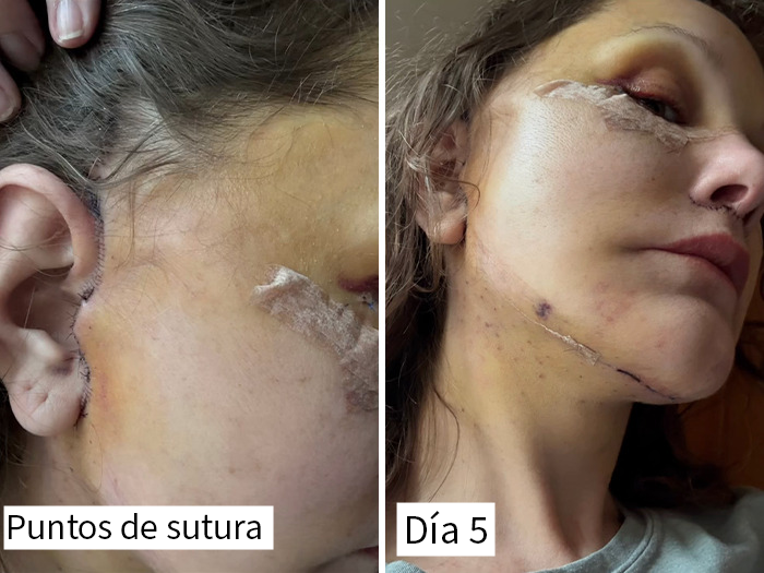 Herida con puntos de sutura y moretones en rostro tras lifting facial costoso mostrando resultados visibles.