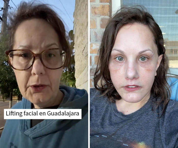 Antes y después del lifting facial en Guadalajara realizado por 15000 dólares que impactó a internet con sus resultados.