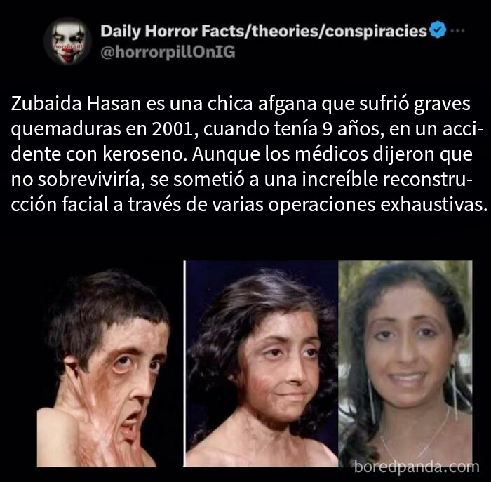 Imágenes terroríficas de la increíble reconstrucción facial de Zubaida Hasan tras graves quemaduras.