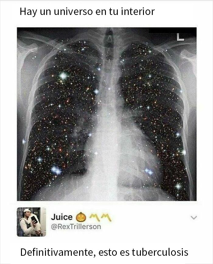 Radiografía con un universo en el interior de los pulmones, meme médico divertido sobre tuberculosis para médicos y público general.