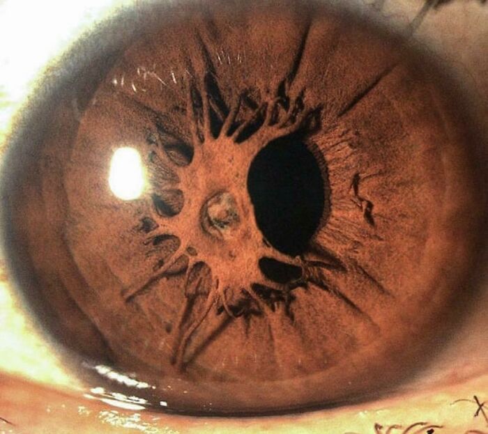 Un iris que crece sobre una pupila