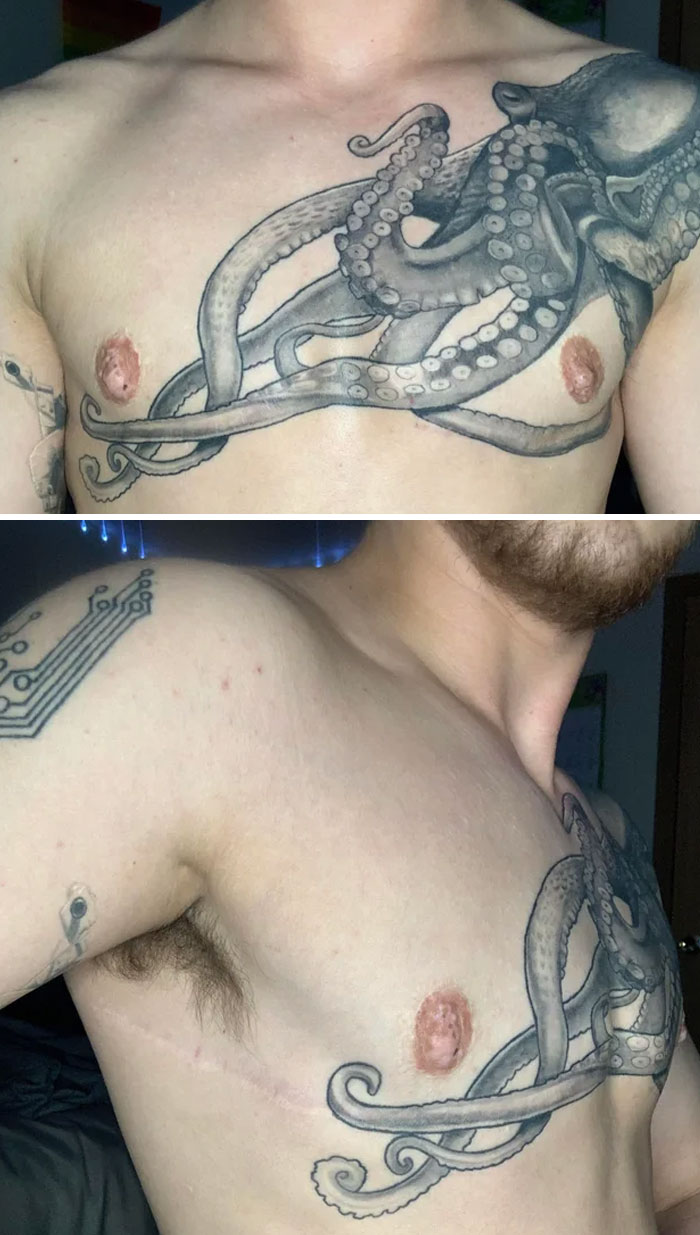 Tatuaje de una cicatriz 3 años después de la operación
