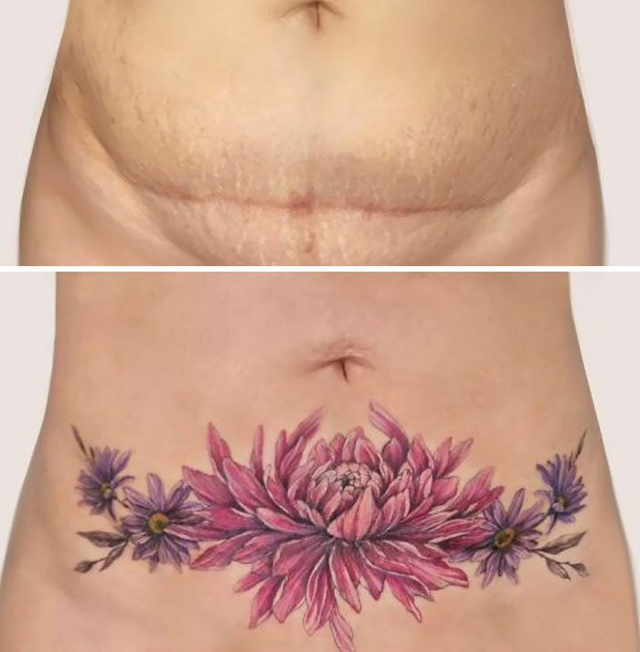 Tatuaje cubriendo una cesárea
