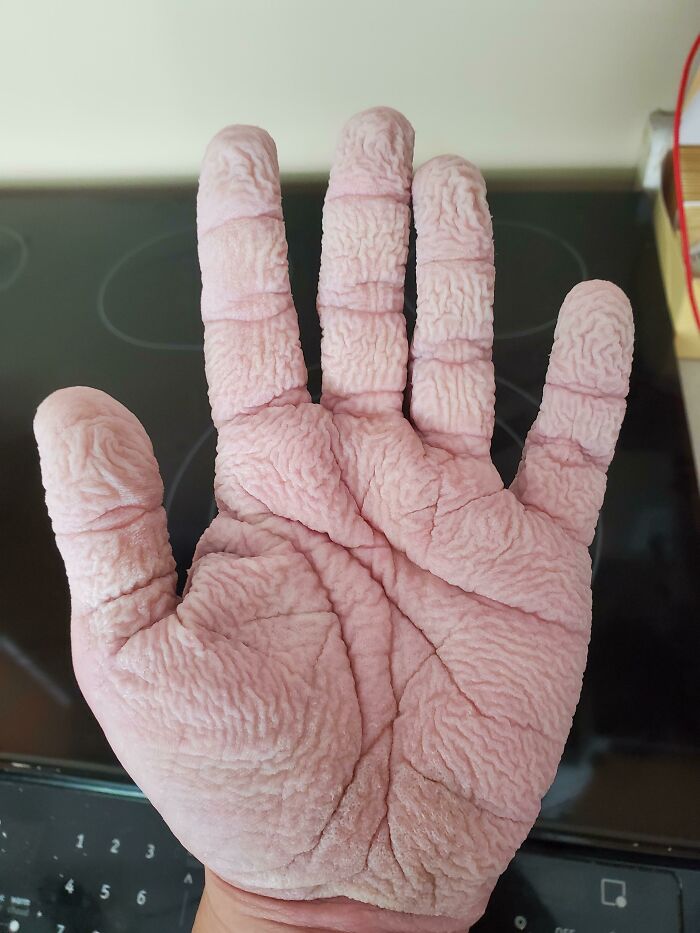 Mis manos después de lavar los trastes durante 20 minutos