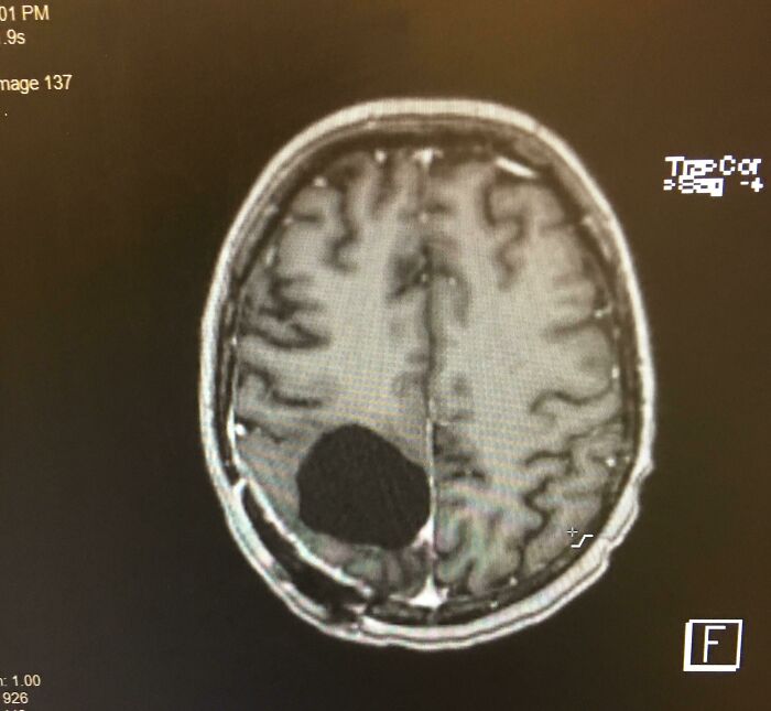 Tras quitar un tumor cerebral