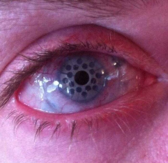 Ojo tras una queratoprotesis: procedimiento quirúrgico en el que se reemplaza una córnea enferma con una artificial