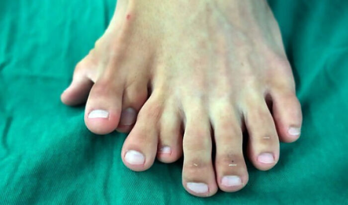 Polidactilia