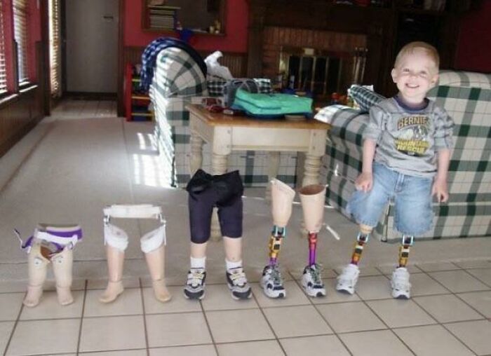 Un adulto puede usar una misma prótesis durante una década, pero un niño requiere varias
