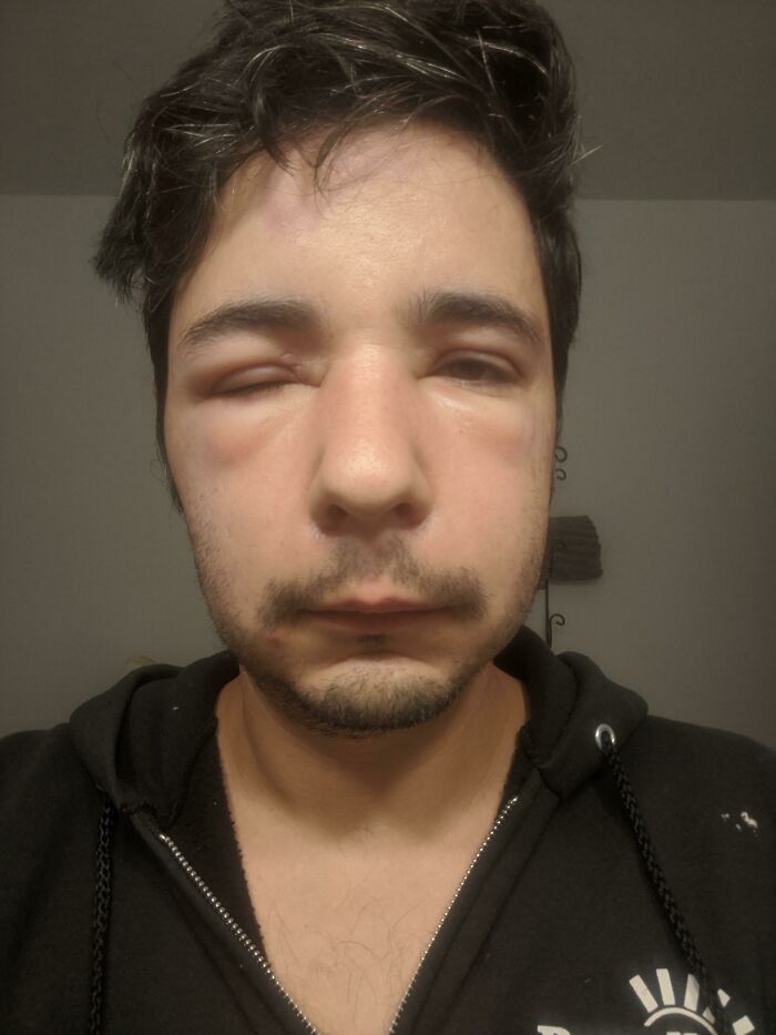 Me picaron dos veces, una vez en la frente y la otra en la punta de la oreja