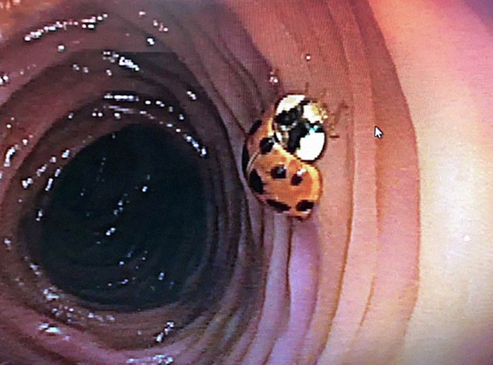 Mariquita encontrada en el colon durante una colonoscopia