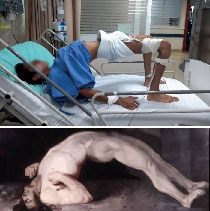 Tétanos en un niño sin vacunar