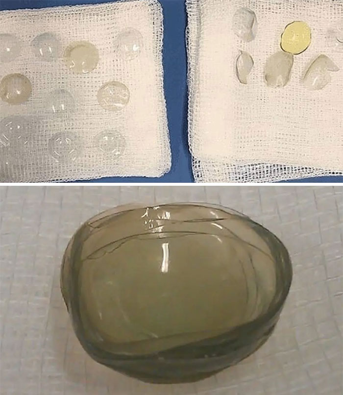 Los médicos encontraron 27 lentillas incrustadas en el ojo de una mujer de 67 años