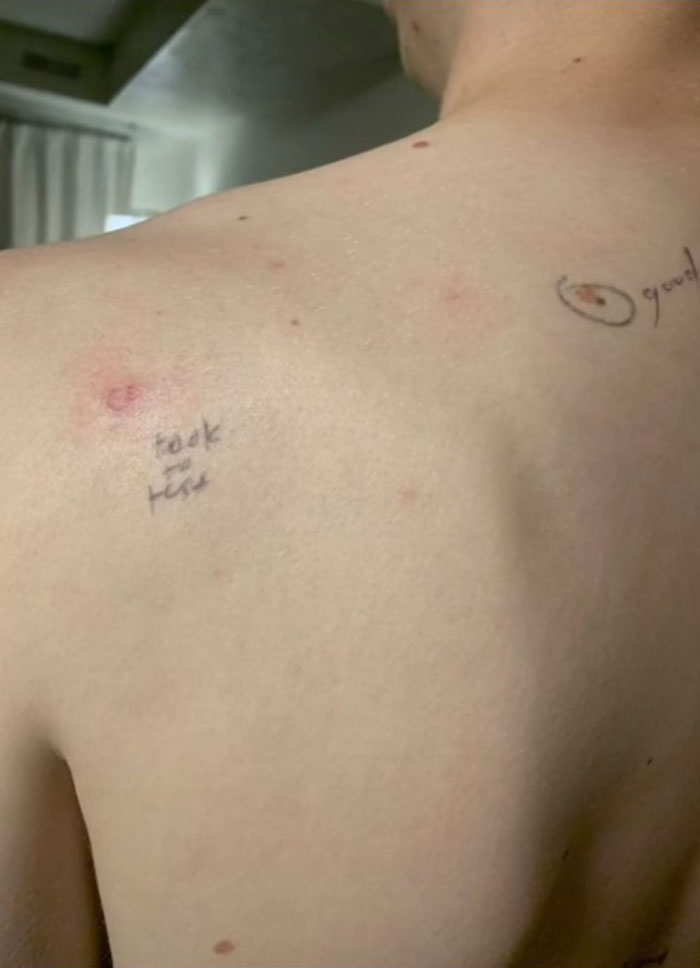 Esta esposa marcó los lunares de su marido antes de que fuera al médico y volvió con notas en su cuerpo