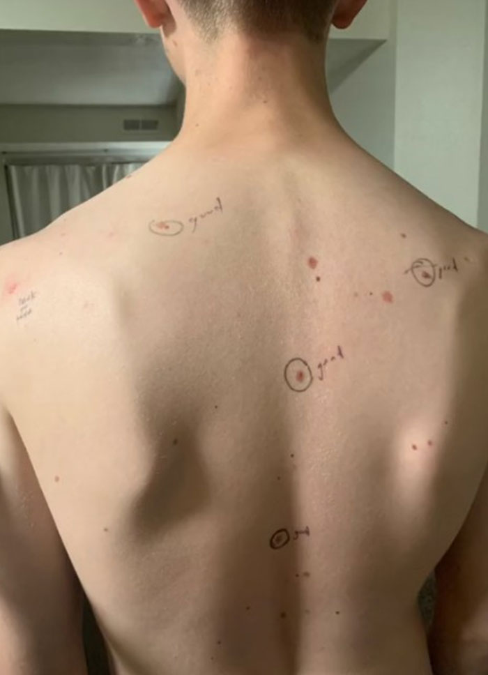 Esta esposa marcó los lunares de su marido antes de que fuera al médico y volvió con notas en su cuerpo