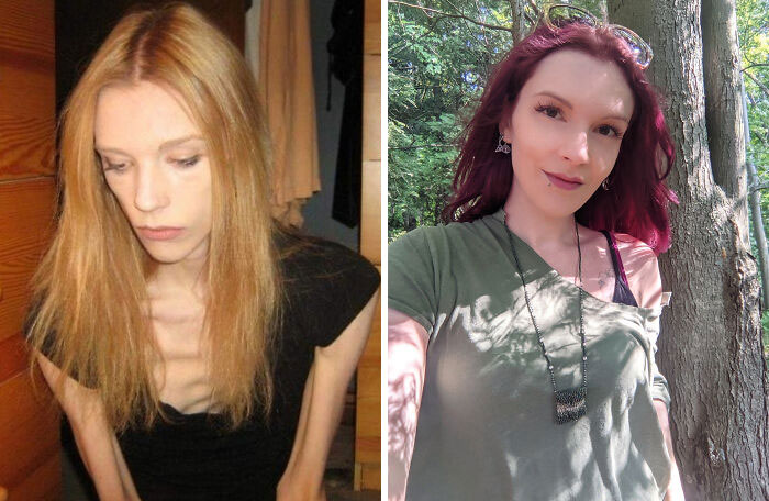 Hoy cumplo 6 meses sin anorexia y bulimia. Es posible recuperarse