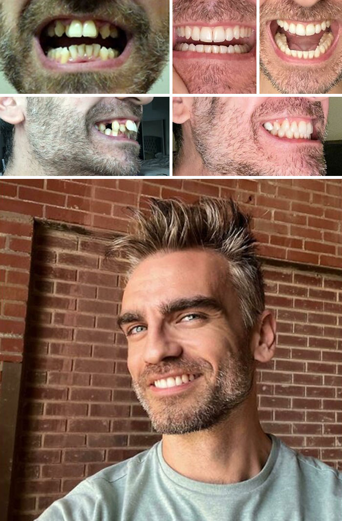 Luego de una vida de tener dientes feos, decidí hacer algo al respecto hace 2 años. Aquí tienen el resultado final. Finalmente terminé