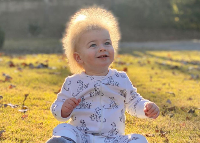 A este alegre niño se le diagnosticó el síndrome del cabello impeinable