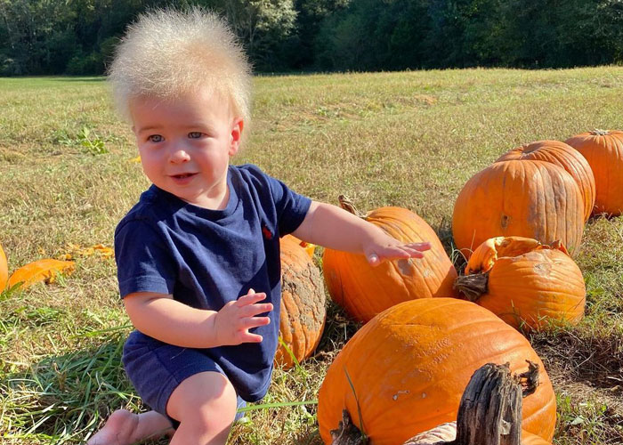 A este alegre niño se le diagnosticó el síndrome del cabello impeinable