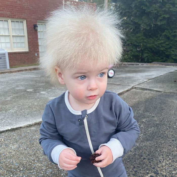 A este alegre niño se le diagnosticó el síndrome del cabello impeinable