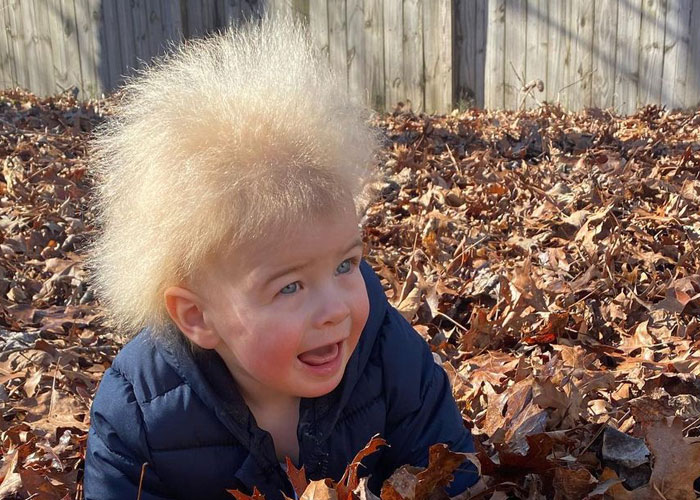 A este alegre niño se le diagnosticó el síndrome del cabello impeinable