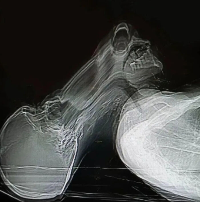 Paciente con claustrofobia teniendo un ataque de pánico durante una tomografía axial
