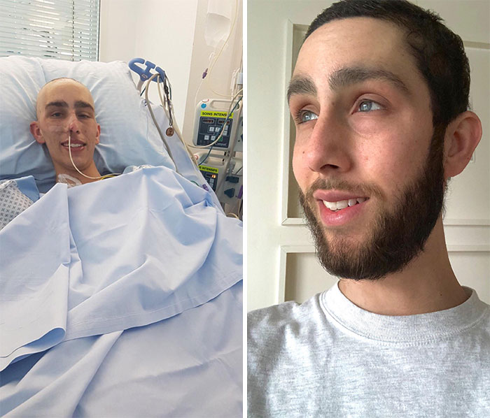 Pasé por la quimioterapia, decidí vencer al cáncer e intenté dejarme crecer la barba por primera vez. Nunca volví la vista atrás