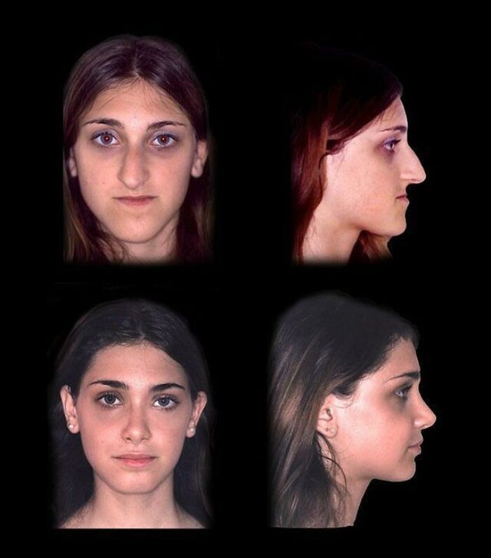 La diferencia tras una rinoplastia y una operación de mandíbula