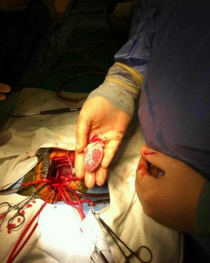 Transplante de corazón pediátrico