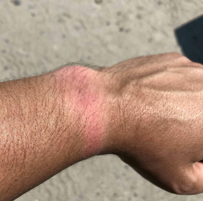 No llevé el reloj a la playa y me quemé con el sol