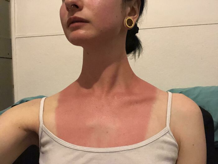 Hoy salí en un barco sin protector solar y ahora tengo lo que estoy llamando 