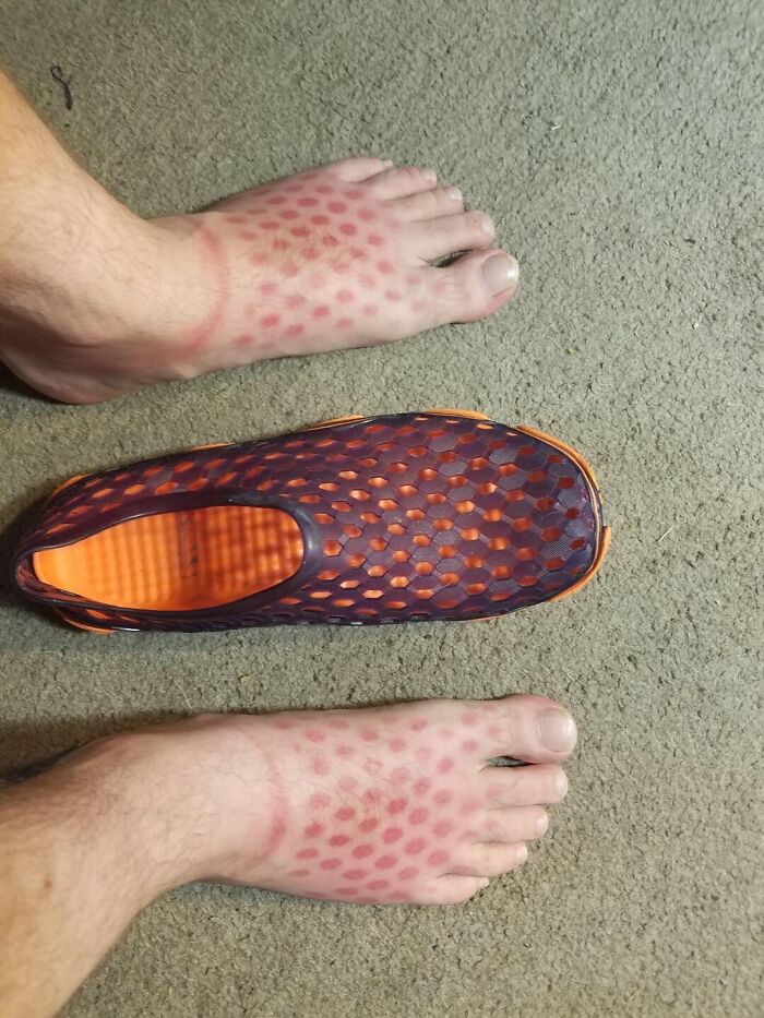 Las líneas de bronceado son sexys, ¿verdad? Cuando te olvidas de ponerte crema solar en los pies