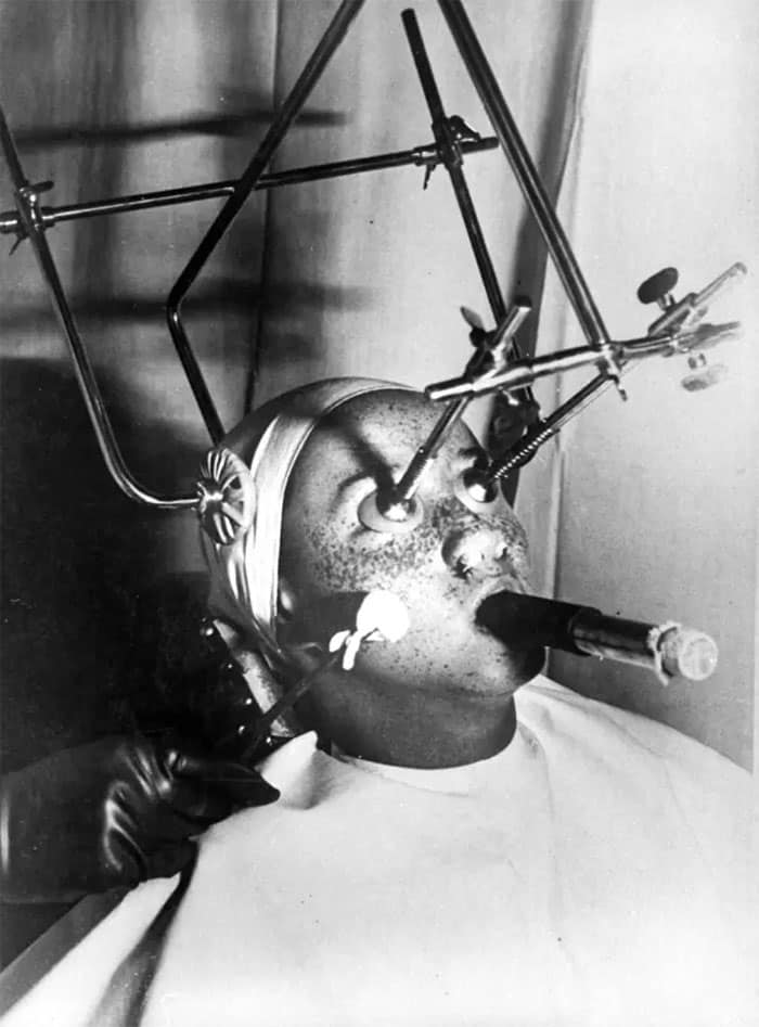 Eliminación de pecas. Se emplea un complicado aparato. Los ojos se cubren con una pieza especial, hermética, y las fosas nasales se rellenan. La respiración se realiza a través de un tubo especial. Las partes sensibles de la cara deben ser tratadas por separado, en 1930