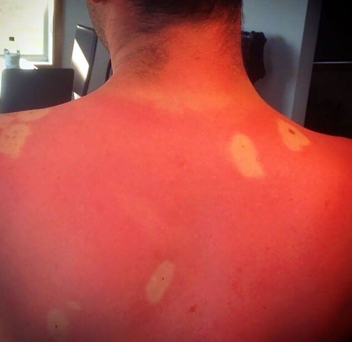 Probablemente debería haber cubierto toda su espalda con protector solar y no solo sus lunares
