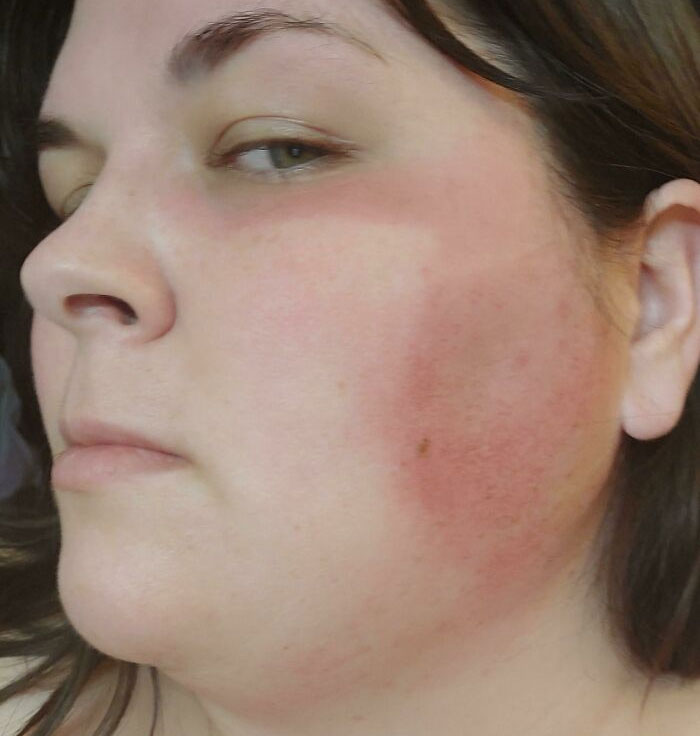 Trabajando en una clínica de vacunas al aire libre. No pensé en la protección solar... Ahora tengo una quemadura solar en forma de mascarilla, pero solo en la mitad de la cara