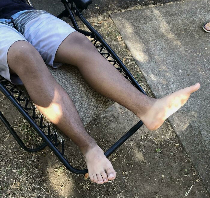 Me bronceé demasiado mientras usaba zapatos. Los niños los llaman mis pies de chimpancé
