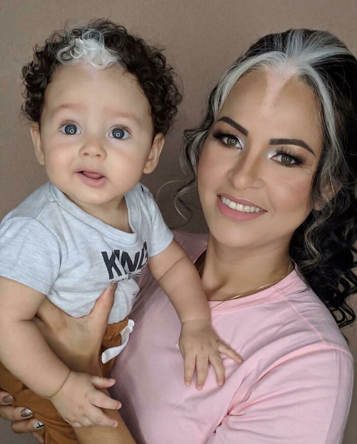 Madre e hijo con poliosis
